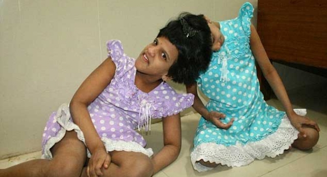 Uk Experts Positive About Surgery For Conjoined Twins News Nation